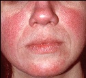 Rosacea stadium 1
